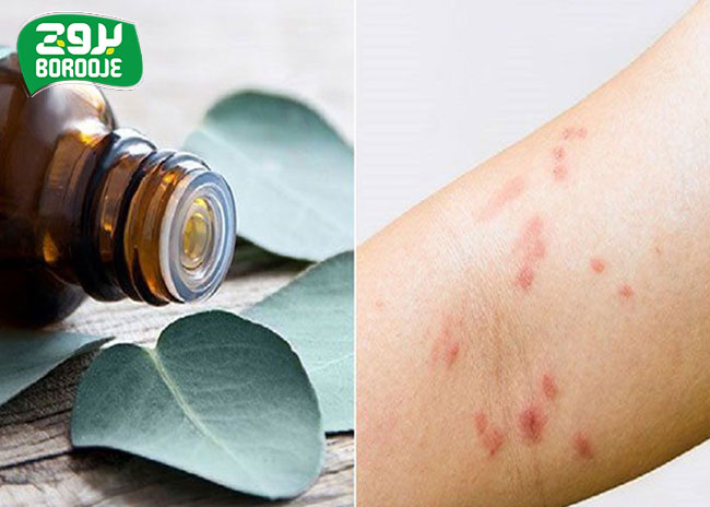 بهترین روغن برای درمان اگزما (کاهش التهاب درماتیت فوری در خانه) 20 نحوه استفاده از بهترین روغن برای درمان اگزما